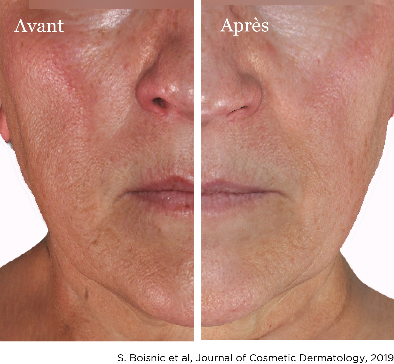 Photo peau du visage avant/après l'utilisation de Lipowheat™